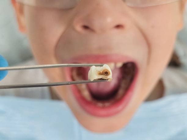Best Emergency Treatment for Dental Infections or Abscesses in Manhasset Hills, NY